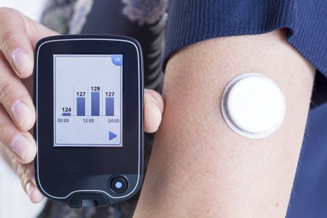 Exploring Automated Insulin Delivery (AID) Systems